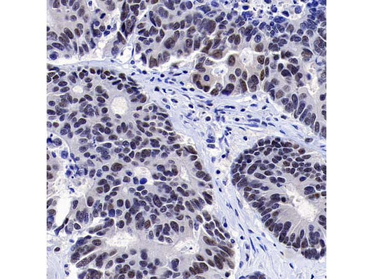 Tumor Pathology Targets: MLH1 and NaPi2b (SLC34A2) Analysis