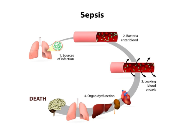 HBP - Sepsis “Key indicators for early diagnosis”