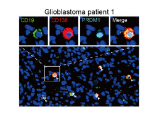 Breaking the Bottleneck in Glioblastoma Research: Absin Facilitates the Discovery of the Critical Link Between Plasma Cells and Cancer Stem Cells