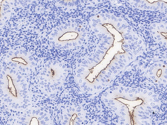 Tumor Pathology Targets: MLH1 and NaPi2b (SLC34A2) Analysis