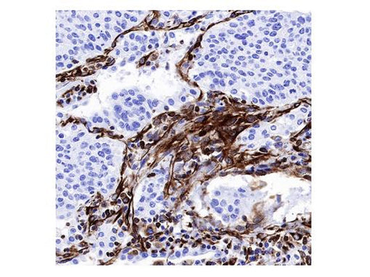 The Pivotal Role of Vimentin-High Macrophages in Immunosuppression of Hepatocellular Carcinoma
