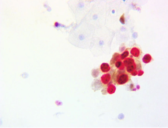 p16/Ki-67 Dual Staining: A Precision Tool for Cervical Precancerous Lesion Diagnosis and ANT BIO PTE. LTD.'s Antibody Solutions