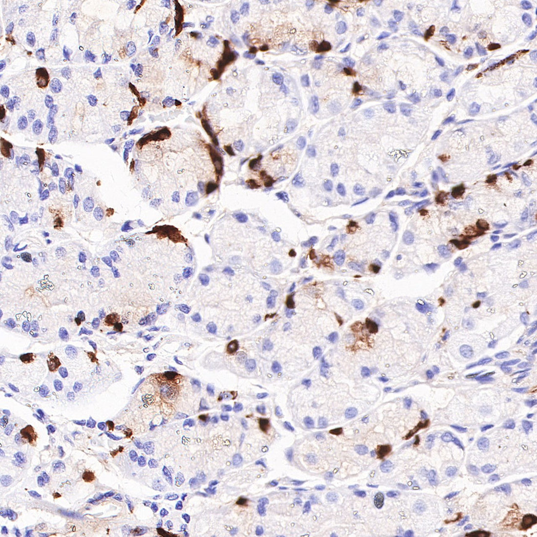 Evaluating the Clinical Value of Chromogranin A Antibodies in Neuroendocrine Tumor Diagnosis and Treatment