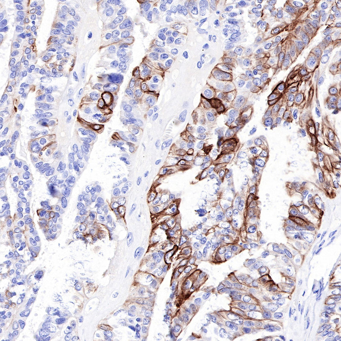 Advancing Pathological Diagnosis of Epithelial-Derived Tumors: Precision Detection with CK-HMW Antibodies