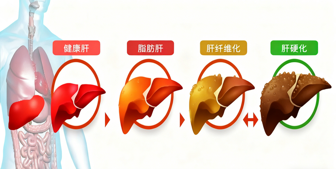 Collagen IV Antibodies: The Sensitive Indicator for Early Screening of Liver Fibrosis