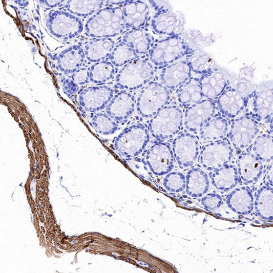 The Diagnostic Value of Desmin Antibodies in Tumor Pathology