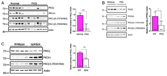 How Does PKCζ Regulate the Disease Progression of Autosomal Dominant Polycystic Kidney Disease?