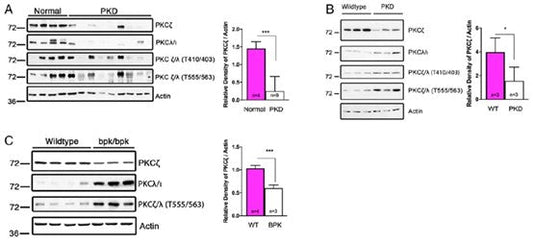 How Does PKCζ Regulate the Disease Progression of Autosomal Dominant Polycystic Kidney Disease?