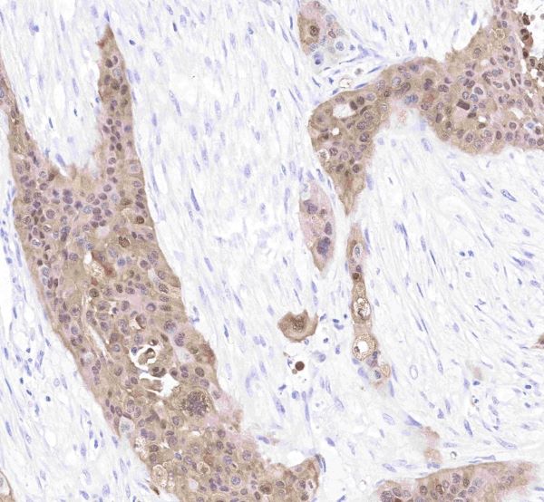 S100 Antibodies: The Cornerstone of Tumor Pathology Diagnosis with ANT BIO PTE. LTD.