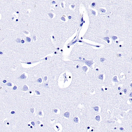 Prolactin/PRL antibody: How to reveal the sex-specific regulatory mechanisms in glioma progression?
