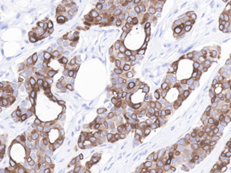 Cytokeratin 7 Antibodies: How Do They Become Key Tools in Breast Cancer Diagnosis?