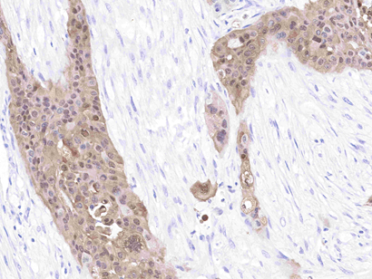S100 Antibodies: How Do They Play a Key Role in Tumor Pathology Diagnosis?