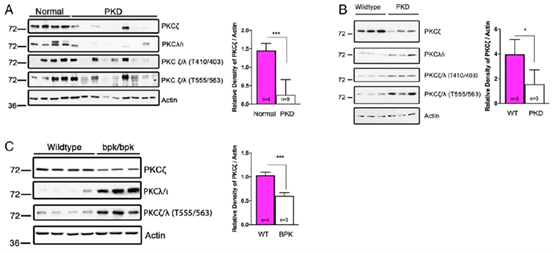 How does PKCζ regulate the disease progression of autosomal dominant polycystic kidney disease?