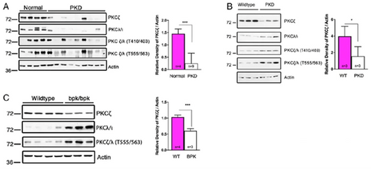How does PKCζ regulate the disease progression of autosomal dominant polycystic kidney disease?