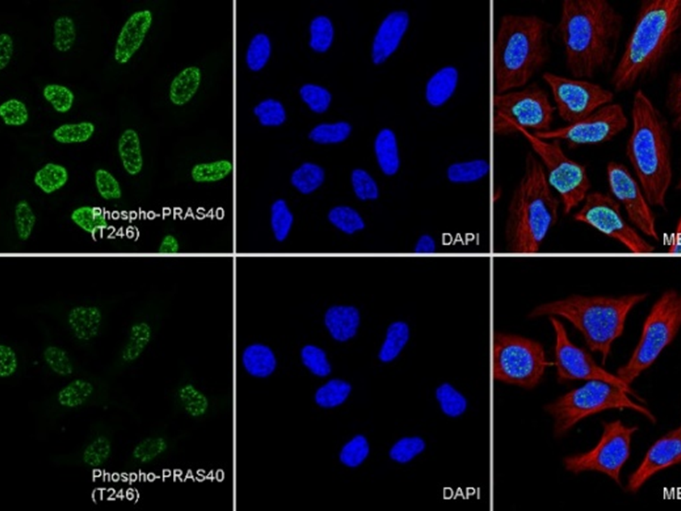 How does the regulatory state of PRAS40 (Thr246) affect the progression and prognosis of clear cell renal cell carcinoma?