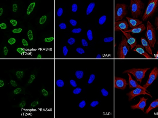 How does the regulatory state of PRAS40 (Thr246) affect the progression and prognosis of clear cell renal cell carcinoma?