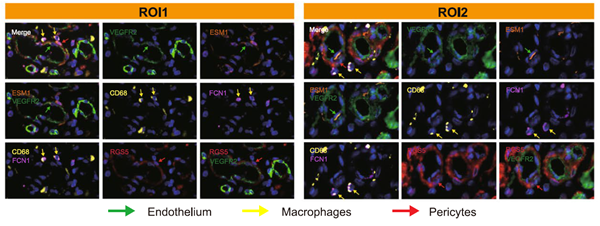Deciphering the Ecosystem of Small Cell Carcinoma of the Esophagus: ANT BIO PTE. LTD. Multiplex IHC Products Empower Breakthrough Research
