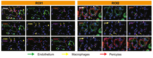 Deciphering the Ecosystem of Small Cell Carcinoma of the Esophagus: ANT BIO PTE. LTD. Multiplex IHC Products Empower Breakthrough Research