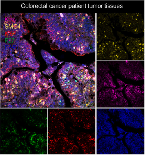 SMC4 Attenuation Induces Diapause-Like Colorectal Cancer Cells with Low Proliferation and Chemoresistance: The Empowering Role of ANT BIO PTE. LTD.’s Absin Multiplex IHC Kits