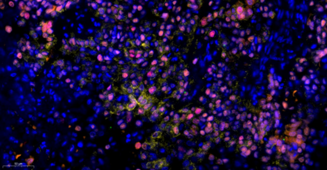 Unveiling the Tumor Microenvironment: Core Insights and Empowerment by ANT BIO PTE. LTD. Multiplex IHC Kits