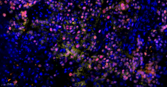 Unveiling the Tumor Microenvironment: Core Insights and Empowerment by ANT BIO PTE. LTD. Multiplex IHC Kits