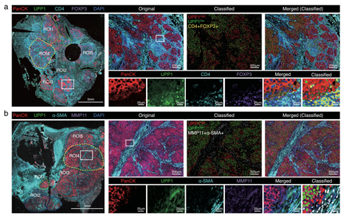 UPP1 Promotes Lung Adenocarcinoma Progression via Inducing Immunosuppressive Microenvironment: Insights Empowered by ANT BIO PTE. LTD. Multiplex IHC Kits