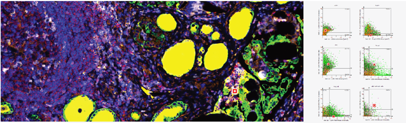 Comprehensive Solution: 7-Color Multiplex Fluorescence IHC for Thyroid Tumor Immune Microenvironment Analysis