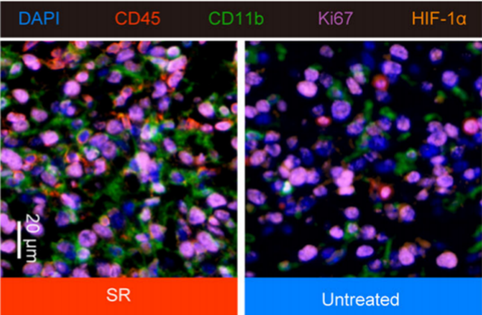 Literature Analysis: A Novel Nanodrug Inhibits Postoperative Cancer Recurrence and Metastasis Supported by ANT BIO PTE. LTD. Products