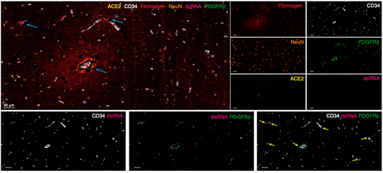 Literature Analysis: Multiplex Fluorescence IHC Empowers Research on SARS-CoV-2 Brain Invasion Mechanisms