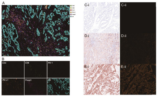 Literature Analysis: Immune Profiling of Advanced Thyroid Cancer Using Multiplex Fluorescence IHC, Empowered by ANT BIO's Solutions