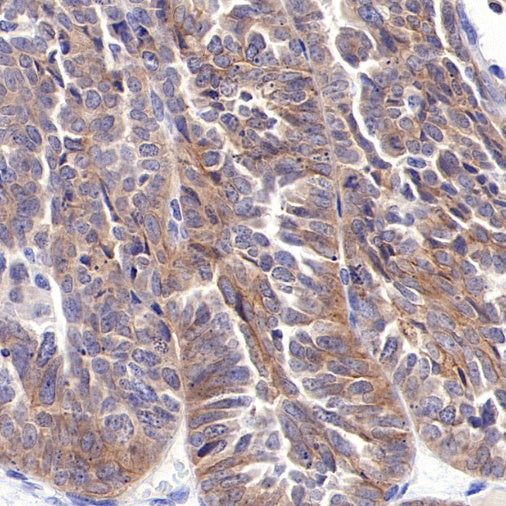 FRα Antibody Guides Targeted Therapy Decisions for Ovarian Cancer