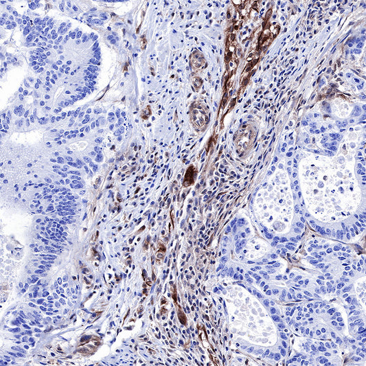 PTEN Companion Diagnostic Antibodies Direct Precision Cancer Therapy
