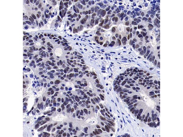 Tumor Pathology Targets: MLH1 and NaPi2b (SLC34A2) Analysis