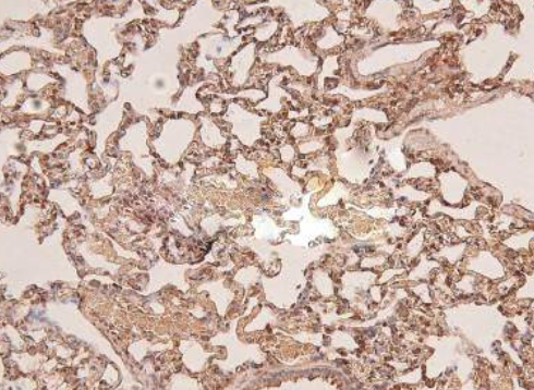 Research Advances on the FGFR3 K650Q Missense Mutation
