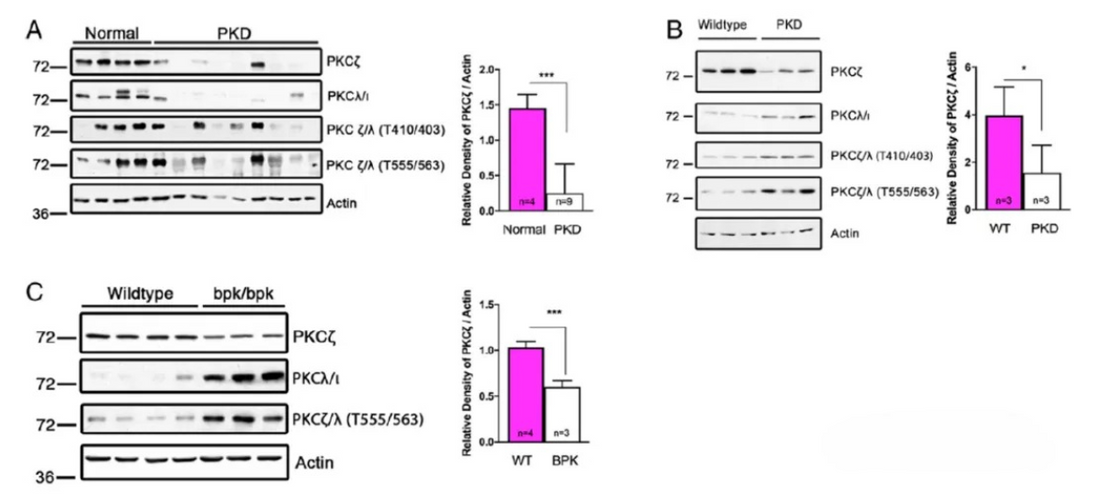 How Atypical PKCζ Regulates Pathological Progression in Autosomal Dominant Polycystic Kidney Disease