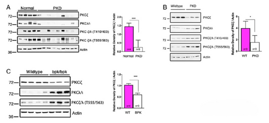 How Atypical PKCζ Regulates Pathological Progression in Autosomal Dominant Polycystic Kidney Disease