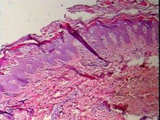 How Do Keratin 10 Antibodies Reveal the Pathogenic Mechanism of Bullous Congenital Ichthyosiform Erythroderma?