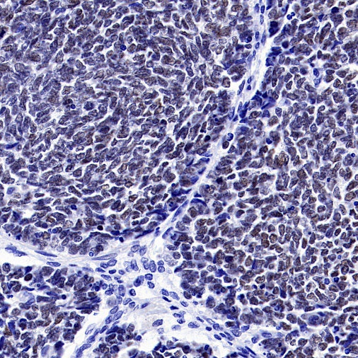 Wilms Tumor Protein (WT1) Recombinant Rabbit mAb (SDT-2864)
