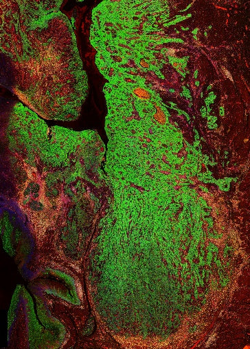 CK-Pan, CD45, CD31 Antibody Panel